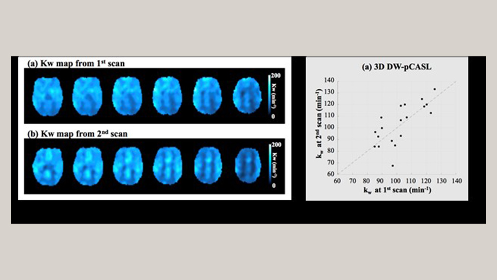Water exchange rate (kw) brain mapping in a 72-year old subject with Mild Cognitive Impairment